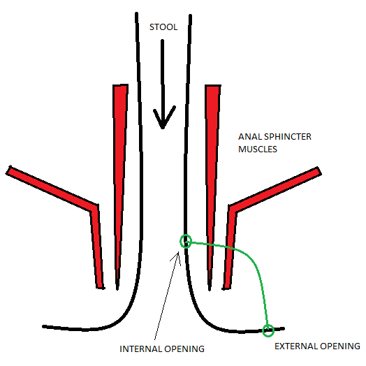 Diagram illustrating the anal sphincter muscles and their openings related to stool passage.